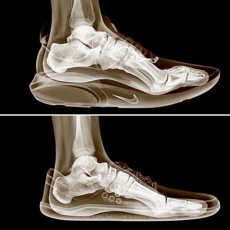 xray images of cushioned shoe and zero-drop shoe